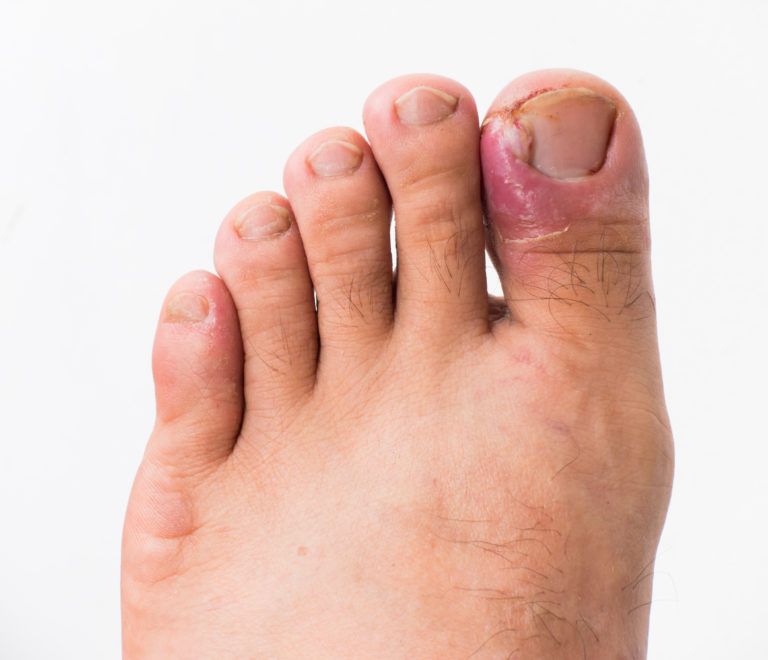 Identifying When Your Ingrown Toenail Requires Medical Attention: Eric  Blanson, DPM: Sports Medicine