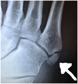 Growth Plate Injuries in the Young Teenage Foot