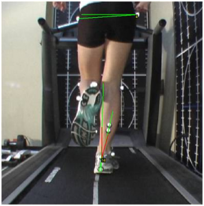 Assessment of leg length discrepancy