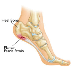Treating Heel Pain and Plantar 