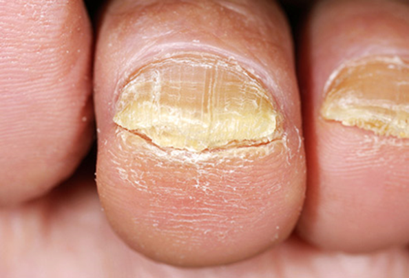 Why do our toenails thicken as we age?