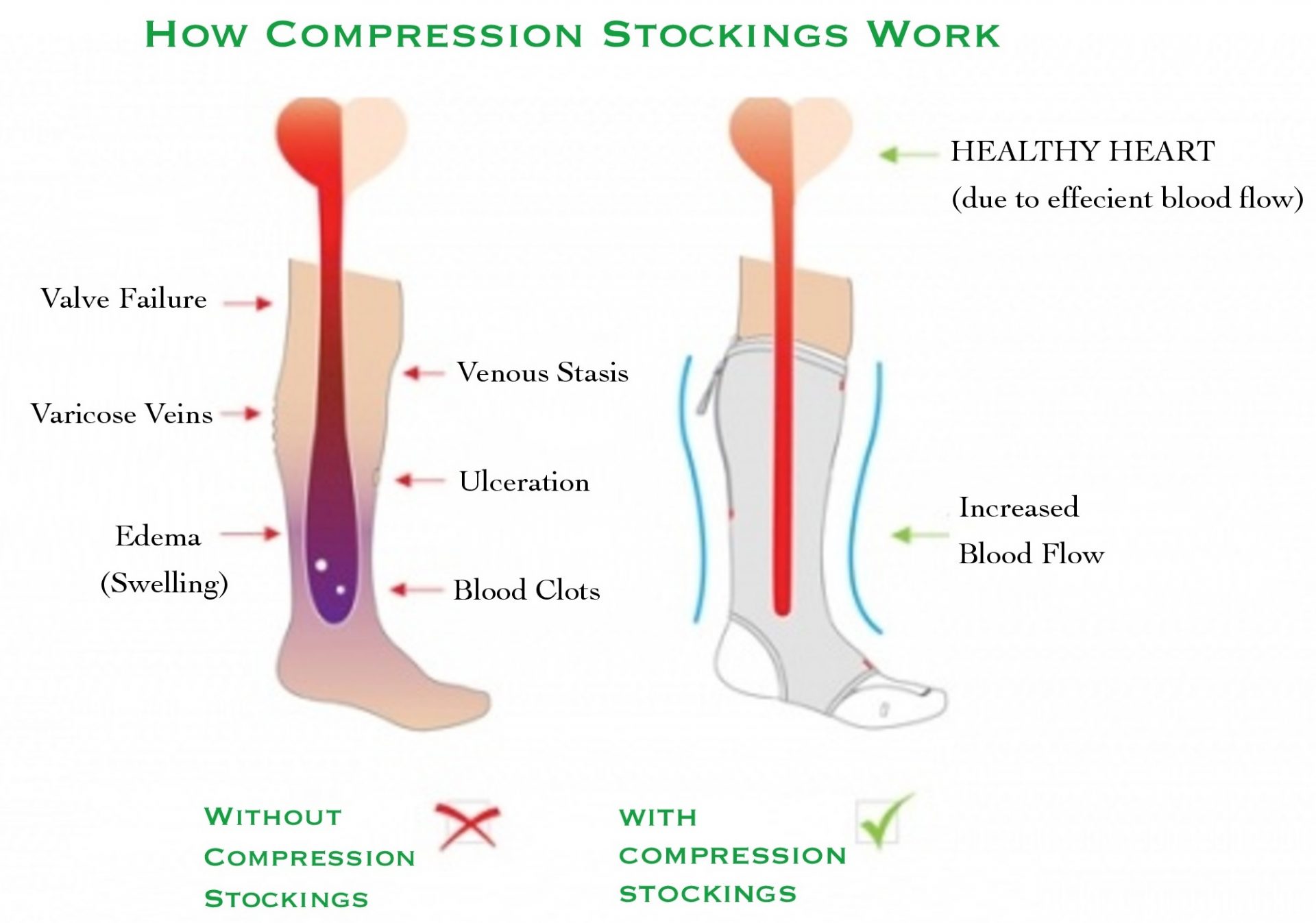 Compression Socks Medical Support Stockings Treatment Swelling, Varicose  Veins