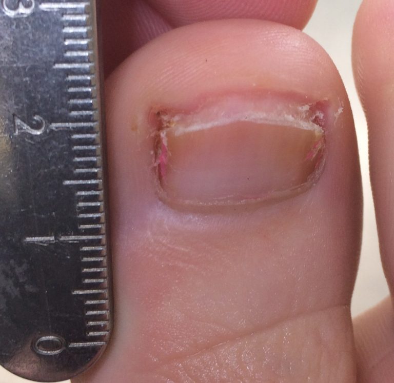 Laser for fungal nail infections: Results you can expect to see