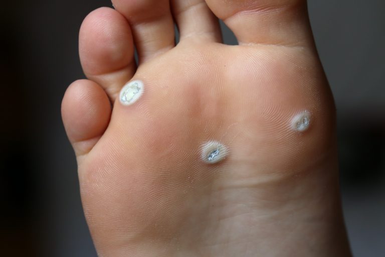 Warts on Feet, Veruccas, Plantar Warts Masterton Foot Clinic, NZ