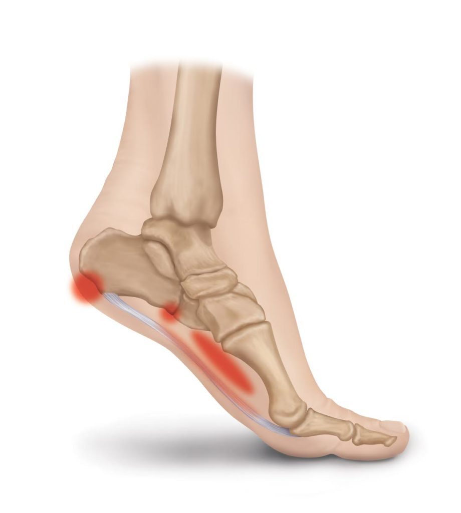 Heel Pain Treatment With Cortisone Shot | Healthy Feet Podiatry