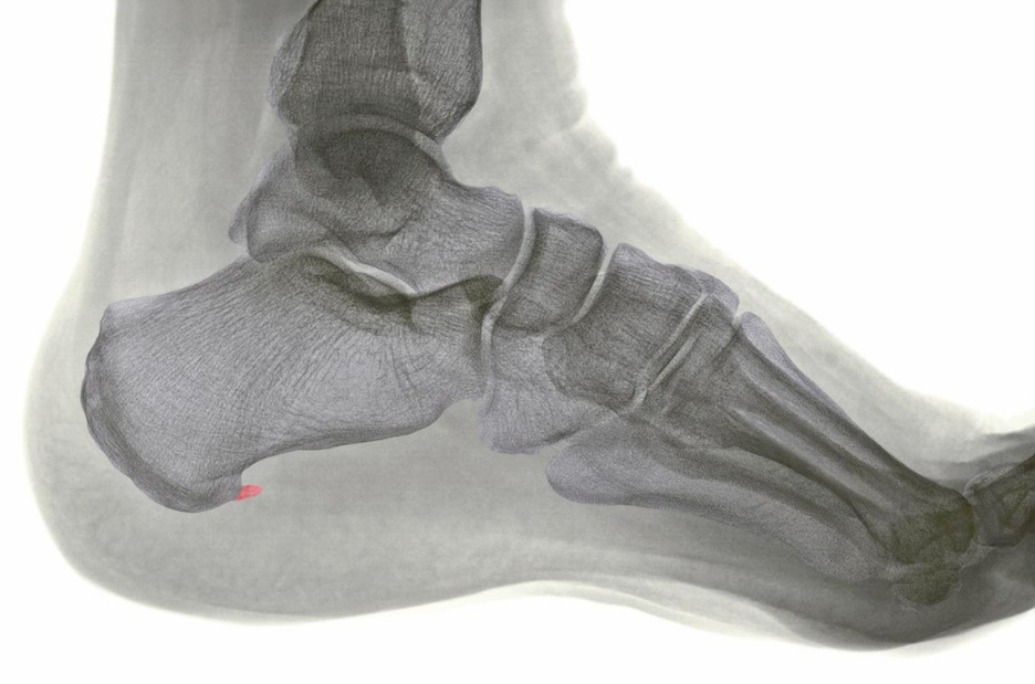 Everything You Need to Know About X-rays for Heel Pain | Heel That Pain