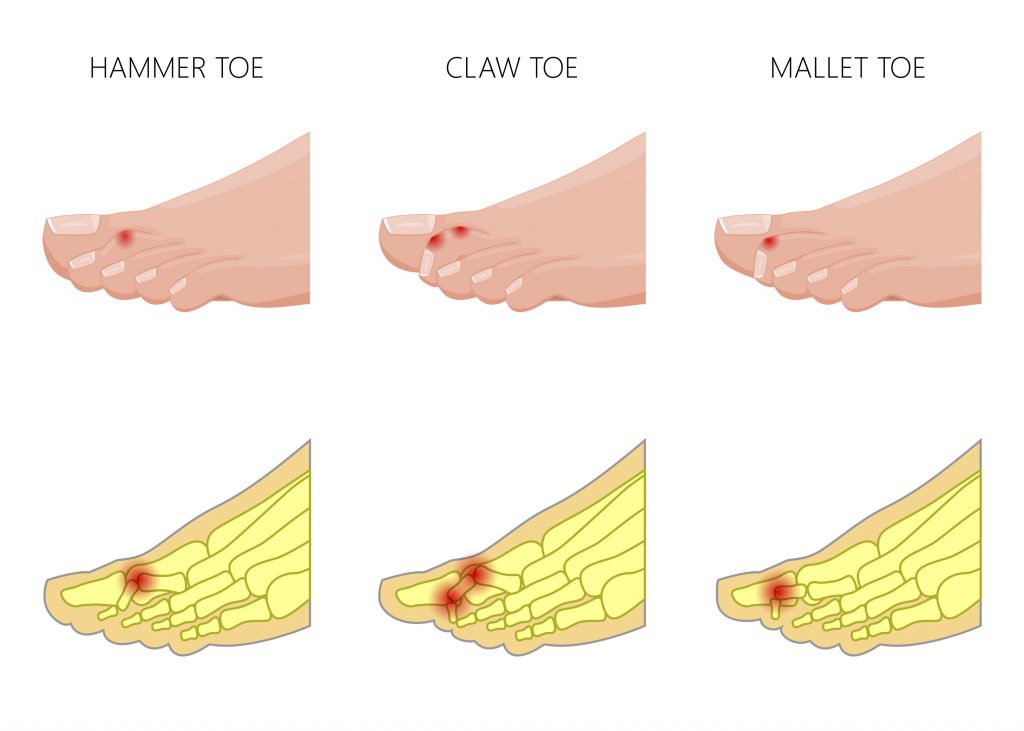 Claw toe : exercises and prevention of deformity