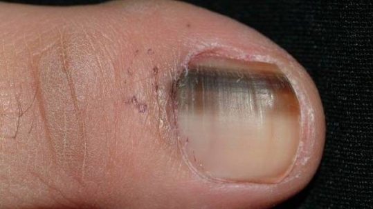 the-brown-spot-on-your-nail-a-melanoma-or-a-simple-bleed