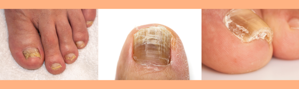Dealing With Thicker Toenails