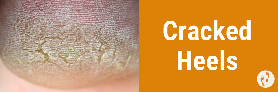 cracked-heels-causes-and-treatment | MyFootShop.com