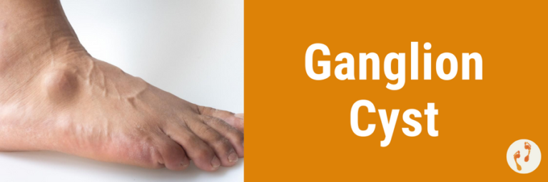 Ganglion Cyst