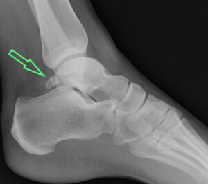 Os Trigonum Syndrome